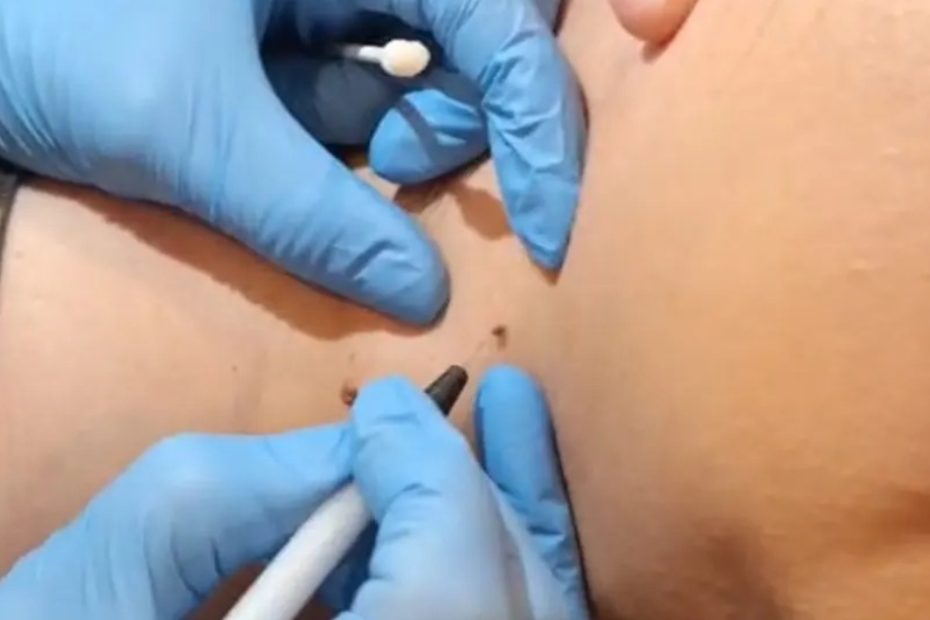 Skin tag treatment using the Skin Classic