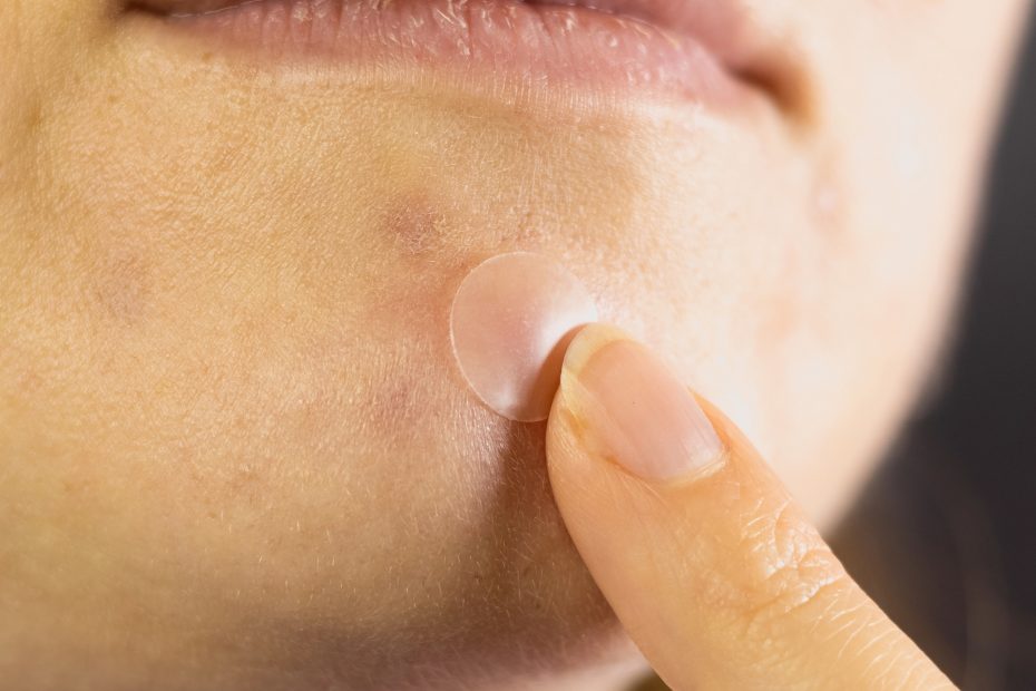 Woman applying a pimple patch on her chin, Linde Esthetics & Wellness Studio Springfield MO