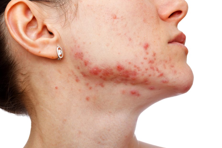 Young woman with acne along her jawline, linde esthetics & wellness studio, springfield MO