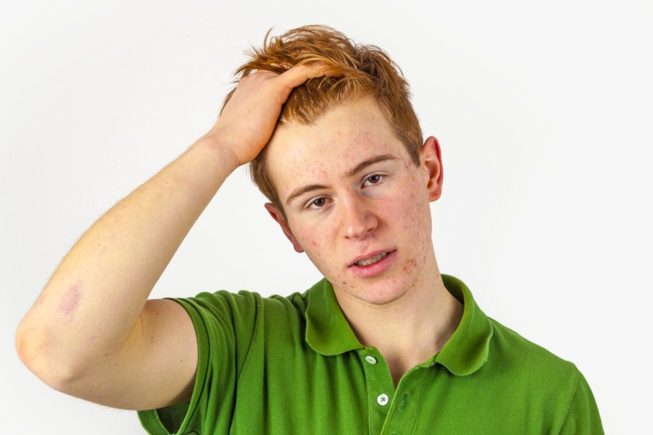 Young man with acne at Linde Eshtetics & Wellness Studio in Springield MO